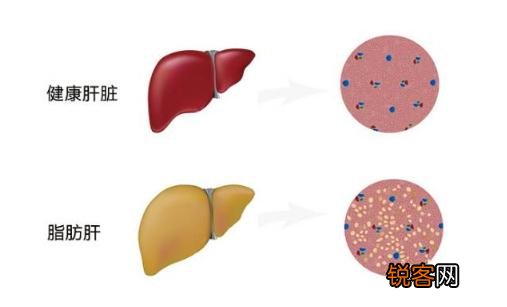 脂肪肝的治疗方法 应酬男应该看看