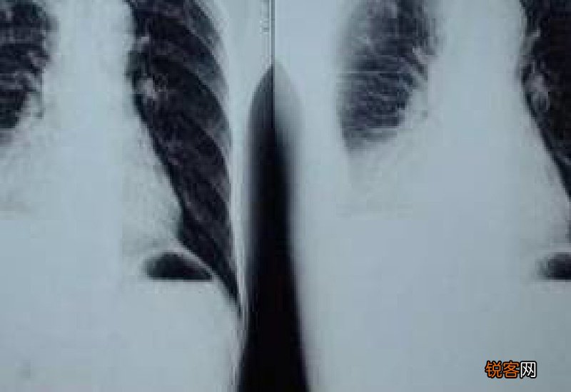 胸膜炎有什么症状？胸膜炎的症状