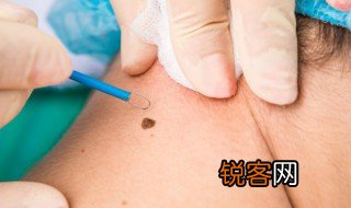 痦子怎么读 痦子的读音