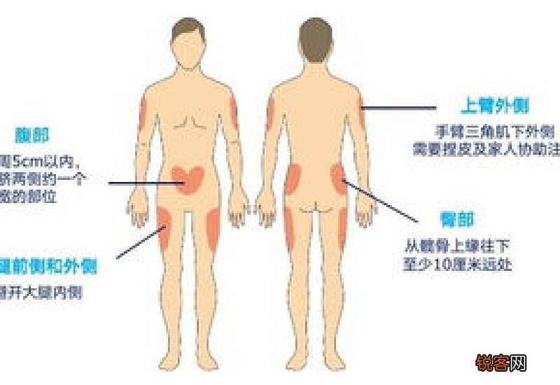 胰岛素注射部位是否有讲究 打哪里吸收最快 4个部位一文讲清楚
