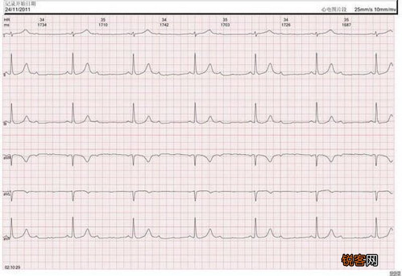 血压高 要先控制“心率” 若心跳不低于这个范围 不用太担心