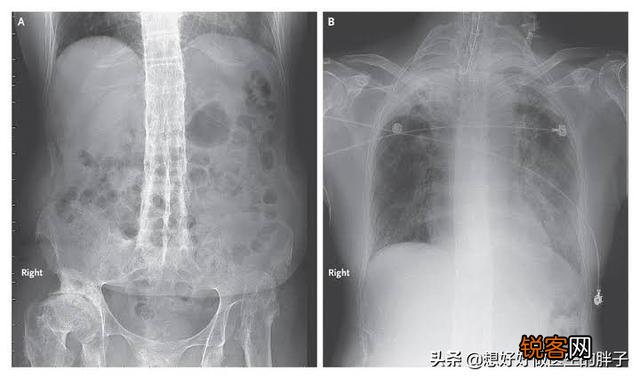 强直性脊柱炎能活多久？