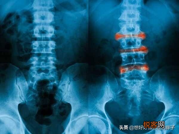 强直性脊柱炎能活多久？