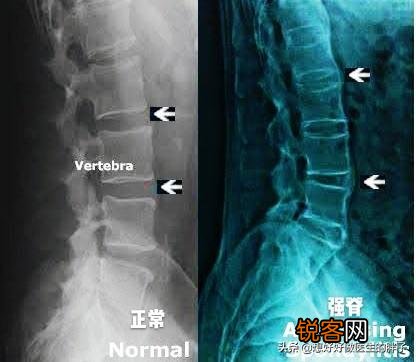 强直性脊柱炎能活多久？