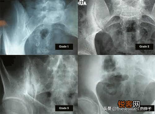 强直性脊柱炎能活多久？