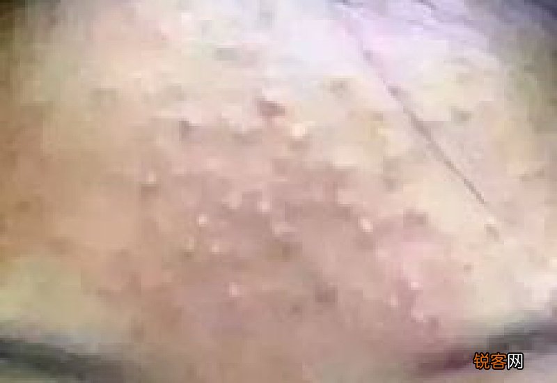 闭口痘痘和普通痘痘一样吗 闭口痘痘和普通痘痘有什么区别