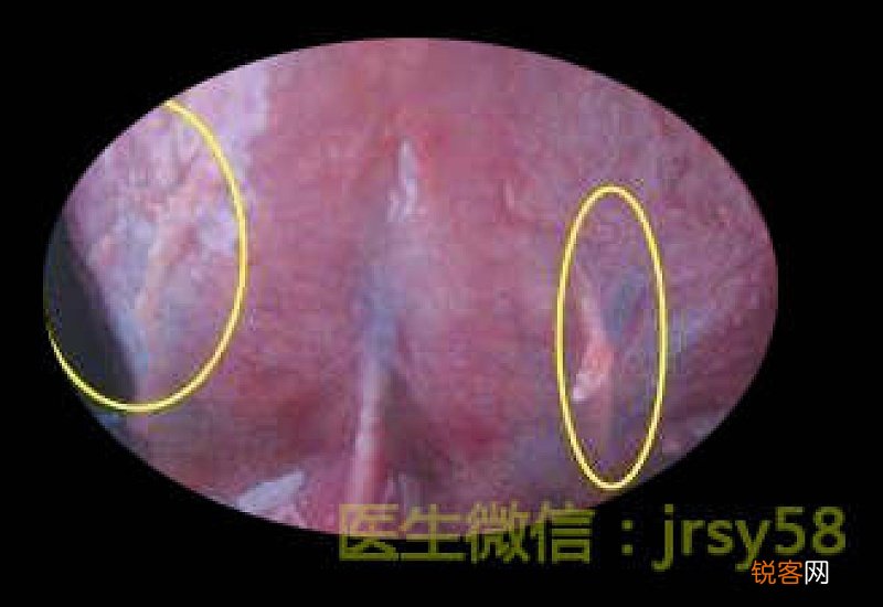 湿疣是什么 尖锐湿有哪些症状