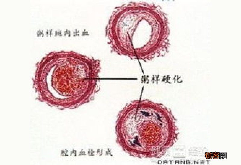 动脉硬化吃什么食物好？动脉硬化的饮食疗法