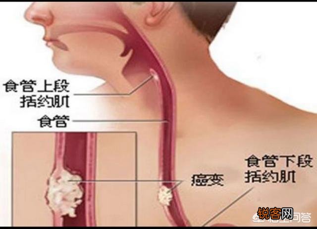食管癌真的是烫出来的吗？