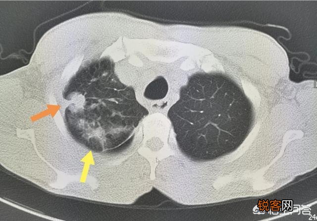 哪种癌症致死率最高？