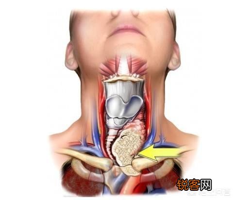 甲状腺癌是什么？