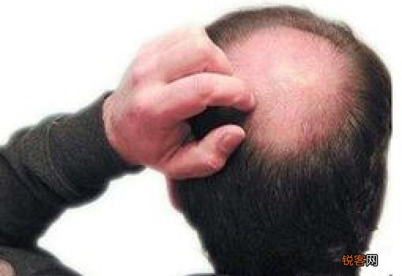 难梳头发综合症是什么东西