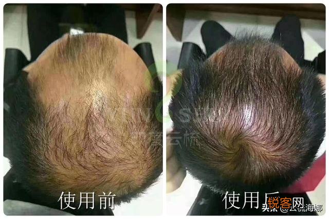 有什么有用的生发洗发水推荐吗？