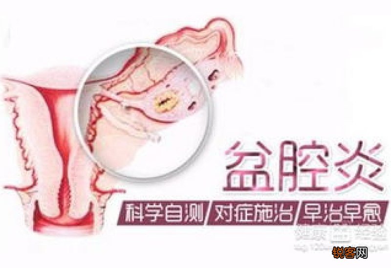 盆腔炎的症状有哪些 盆腔炎的症状是什么