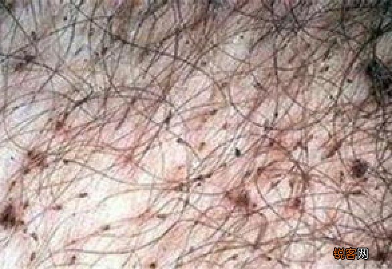 阴虱卵掉床上会存活吗