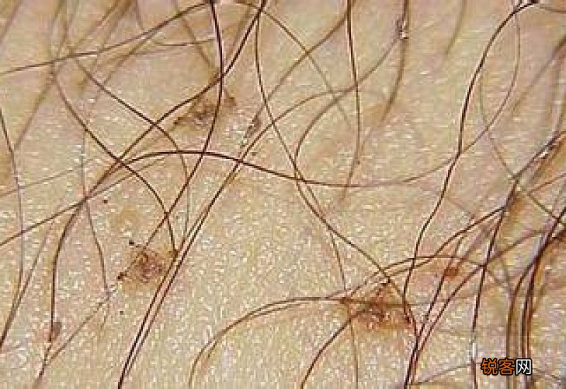 从毛囊里抠出很多阴虱怎么办