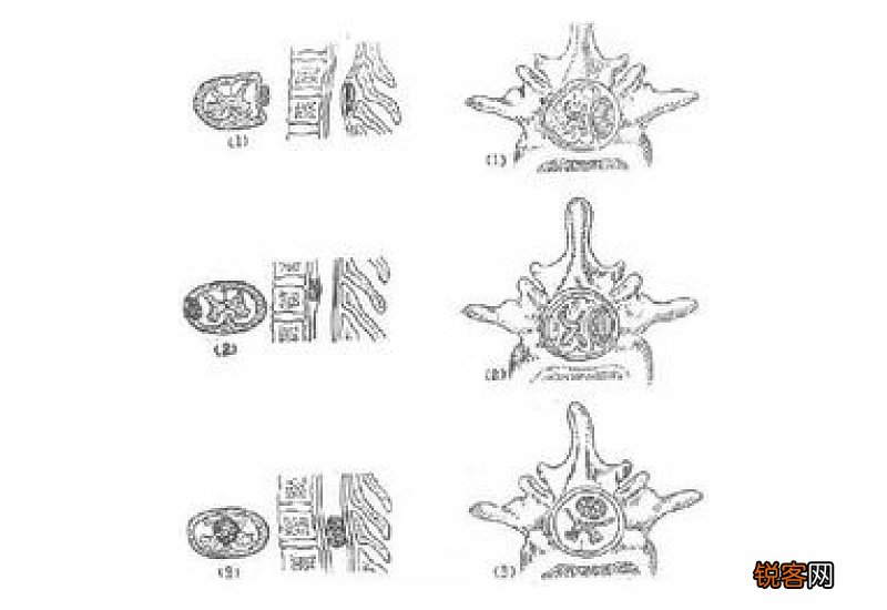 椎管内肿瘤患者吃什么好？椎管内肿瘤饮食原则