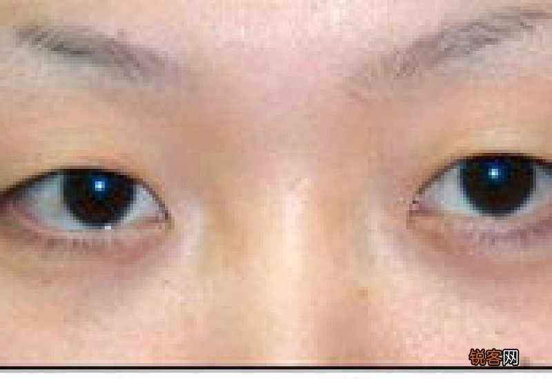 开眼角手术之后需要注意什么 开眼角手术后又哪些注意事项