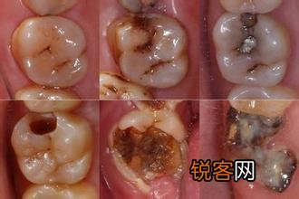 有什么速效方法缓解牙痛吗？