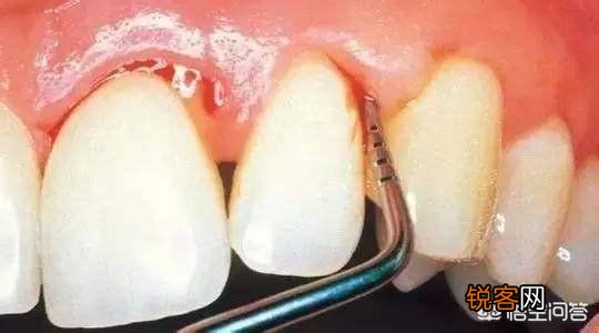 有什么速效方法缓解牙痛吗？