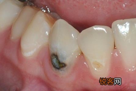有什么速效方法缓解牙痛吗？