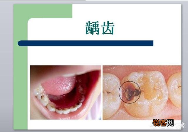 有什么速效方法缓解牙痛吗？