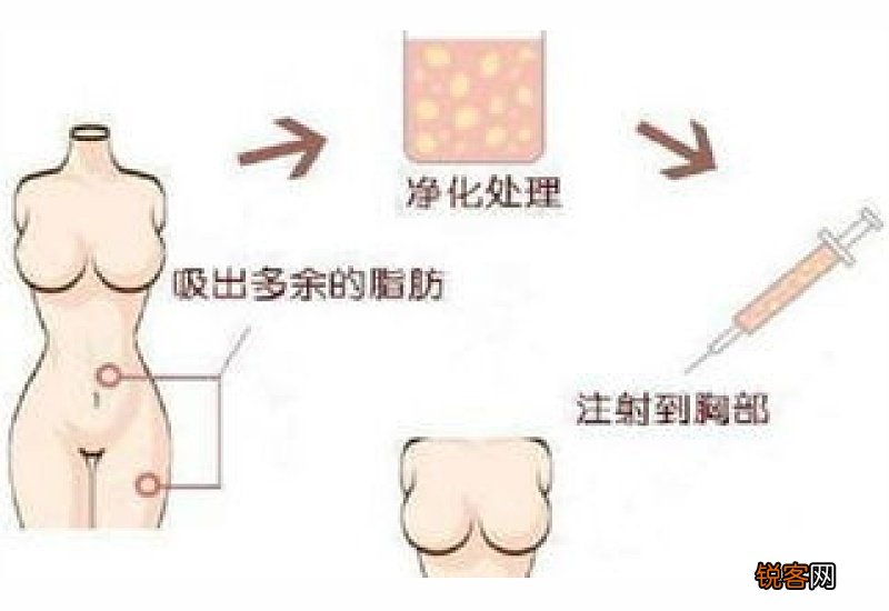 自体脂肪丰胸可以保持多长时间 自体脂肪丰胸效果好不好