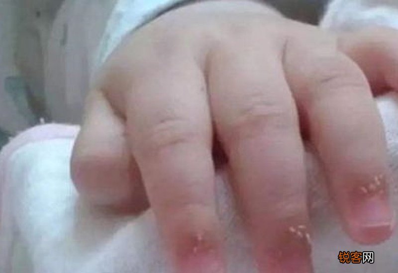 手上长倒刺缺什么维生素