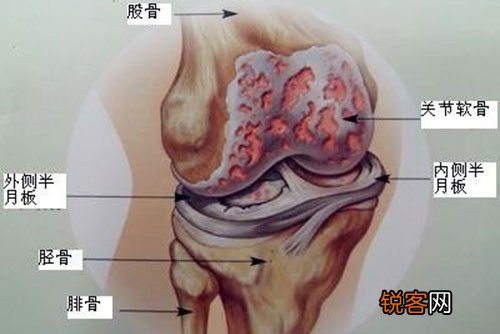 什么是退行性骨关节炎？骨关节炎患者有哪些症状