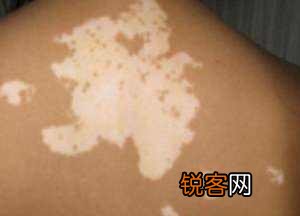 为什么有的人会得白癜风