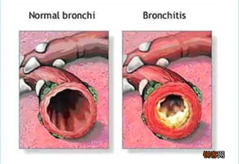 急性支气管炎吃什么比较好 吃什么可以治疗急性支气管炎