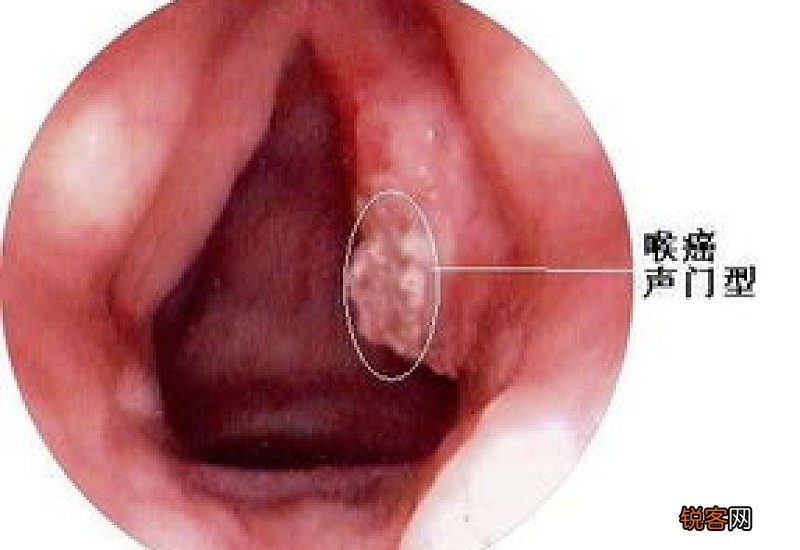 喉癌全切手术后怎么调理 喉癌全切手术后吃什么好