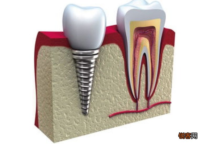 种植牙可以用多久 种植牙能用一辈子吗