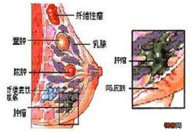 有哪些预防乳腺癌的食物 哪些食物可防治乳腺癌