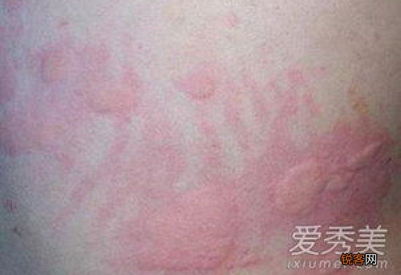 春季为何会皮肤过敏 春季如何预防皮肤过敏