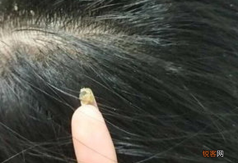 头皮有螨虫用什么可以治