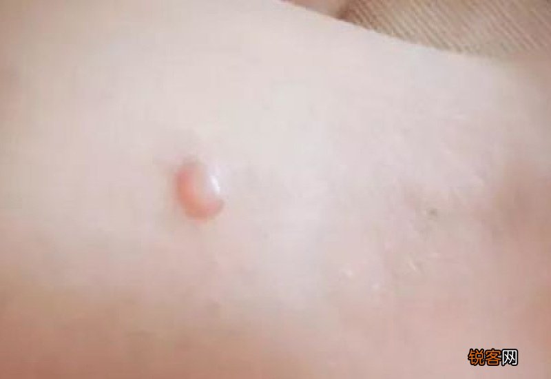 艾灸起水泡和烫伤的区别