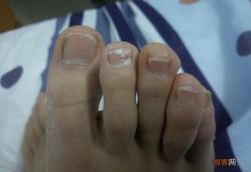 怎么预防脚指甲出现白色横纹