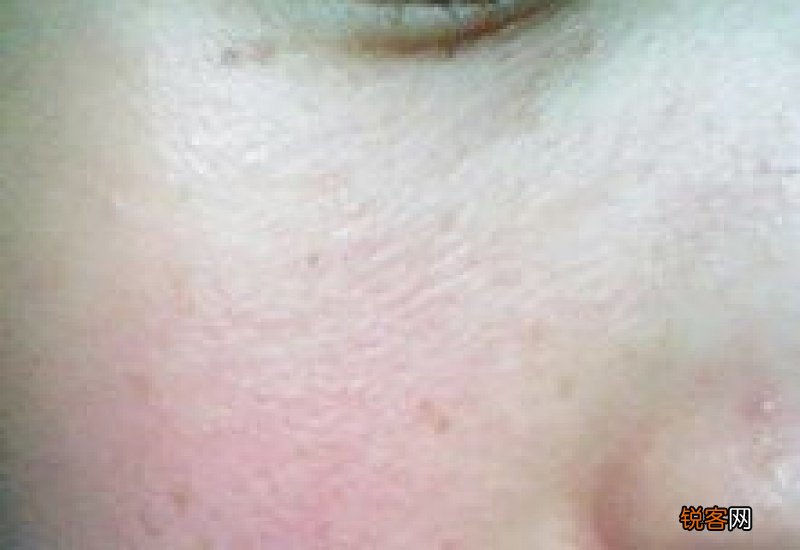 脸上长痱子一样的东西是什么