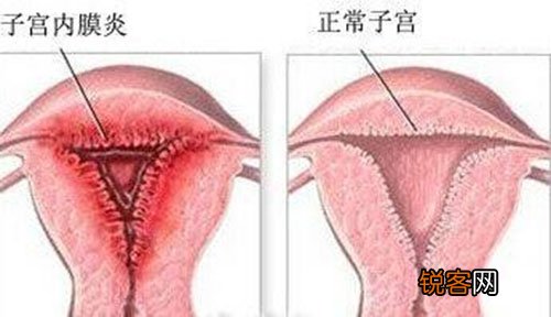 什么是继发性闭经？惹起继发性闭经的缘由有哪些