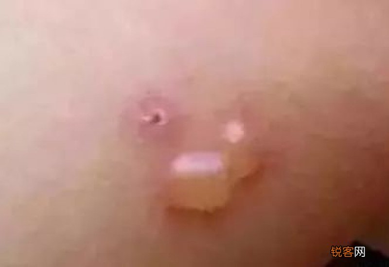 夏天艾灸出水是湿气还是出汗