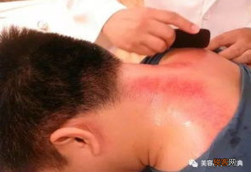 拔血罐可以去除富贵包吗