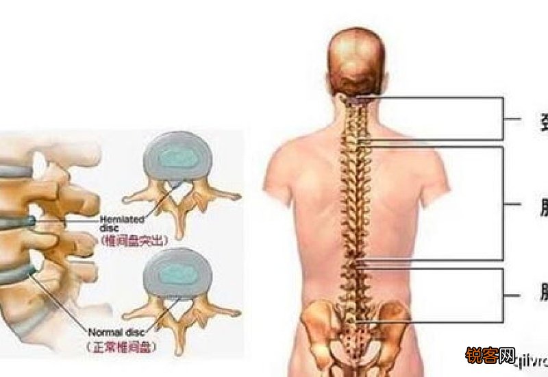 腰间盘突出可以艾灸吗