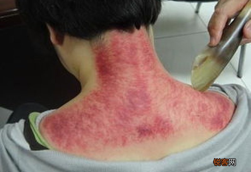 脖子两侧刮痧出痧说明什么