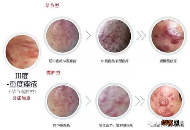 消除肺热引起痘痘最快方法