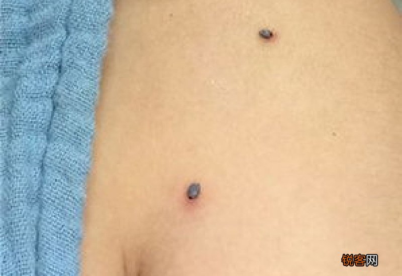 贴完三伏贴可以游泳吗