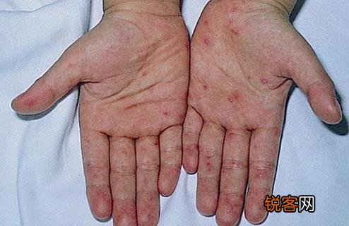 学生手掌出现红点别大意，小朋友手掌红点