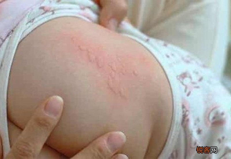 荨麻疹发出来是排毒吗