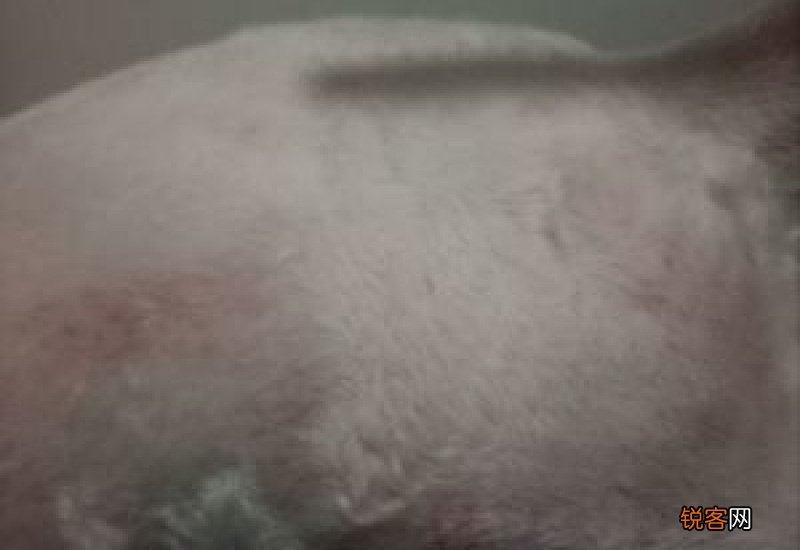 腋毛癣剃了就没了吗