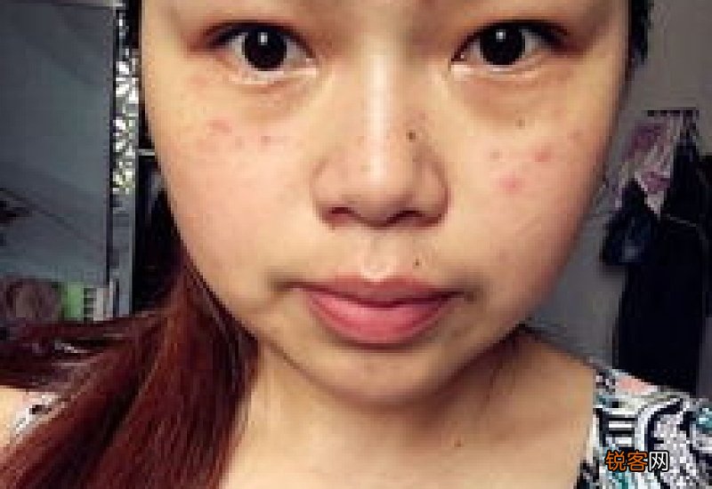 艾灸脸上长痘怎么办